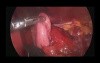 Fundoplication and Heller myotomy