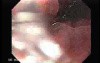 Pill Esophagitis - 1/5