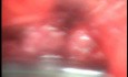 Perforation of a Esophageal Carcinoma after the procedure with hydrostatic balloon dilation (6 of 12)