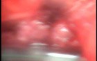 Perforation of a Esophageal Carcinoma after the procedure with hydrostatic balloon dilation (6 of 12)