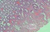 Case on Multiple Adenomas (large polyps) of the Rectum (35 of 37)