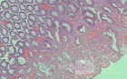 Case on Multiple Adenomas (large polyps) of the Rectum (35 of 37)