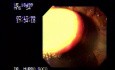 Varices Of The Gastric Fundus - Endoscopy