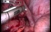 Laparoscopy Due To Pelvic Inflammatory Disease (PID)
