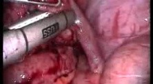 Laparoscopy Due To Pelvic Inflammatory Disease (PID)