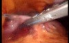 Gastrointestinal Stromal Tumor - GIST (42 of 65)