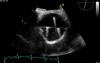 Transesophageal Echocardiography