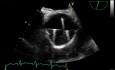 Transesophageal Echocardiography