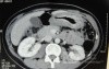 Endoscopy of Scirrhous Gastric Carcinoma involving the entire Fundus, Body and the Antrum (22 of 47)