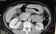 Endoscopy of Scirrhous Gastric Carcinoma involving the entire Fundus, Body and the Antrum (22 of 47)