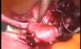 Laparoscopic Polymyomectomy Using A Knew Morcellator