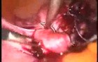 Laparoscopic Polymyomectomy Using A Knew Morcellator