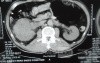 Right Renal Cell Carcinoma