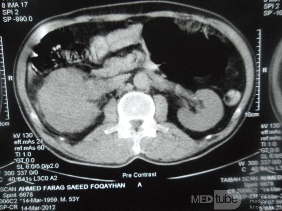 Right Renal Cell Carcinoma