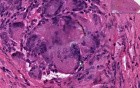 Foreign body reaction - Histopathology - Soft tissue