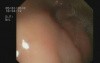 Bulbar Fistula With Purulent Secretion / Bulbar Ulcer Complication