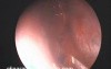 Submucous Resection Of The Nasal Septum