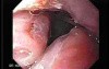 Enlarged Tonsils (1 of 2)