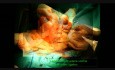 Uterine Artery Ligation During a C-Section