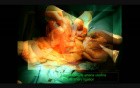 Uterine Artery Ligation During a C-Section