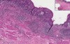 Chronic Esophagitis