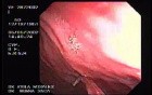 Zollinger- Ellison Syndrome - Gastric Ulcer with Gastrocolic Fistula (13 of 21)