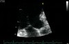SAM  Mitral  (Incomplete Systolic Anterior Motion Chordae)