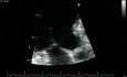 SAM  Mitral  (Incomplete Systolic Anterior Motion Chordae)