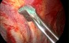 Video-Assisted Thoracoscopic Surgery 3/4