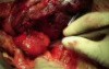 Spigelian hernia repair 