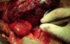 Spigelian hernia repair 