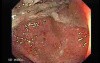 Ulcerative Colitis Complicating Colon Cancer (1 of 4)