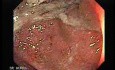 Ulcerative Colitis Complicating Colon Cancer (1 of 4)