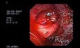 Gastric Varices - Ablation With Cyanoacrylate Glue