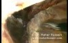 Inguinal Herniorraphy - Laparoscopic Approach