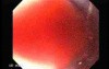 Hemorrhage After Ligation - Banding of Esophageal Varices