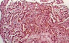 Barrett Adenocarcinoma - Endoscopic Image  (8 of 20)