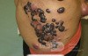 Malignant Melanoma Metastases