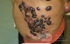 Malignant Melanoma Metastases