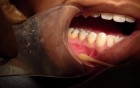 What Is This Thing Called The Mucogingival Junction?