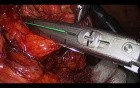 Laparoscopic Resection of the Pancreatic Tail