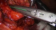 Laparoscopic Resection of the Pancreatic Tail