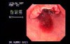 Endoscopy Of Rectal Adenocarcinoma (3 of 4)