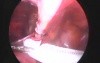 Laparoscopic inguinal hernia repair