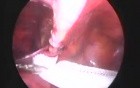 Laparoscopic inguinal hernia repair