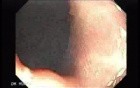Multiple Gastric Angiodysplasia (17 of 17)