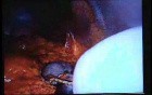 Jejunal Gastrointestinal Stromal tumor (GIST) (86 of 86)