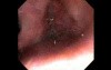 Retroflexion Maneuver Out Of Patient's Body - Endoscopic View Of The Nasal Cavity