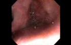 Retroflexion Maneuver Out Of Patient's Body - Endoscopic View Of The Nasal Cavity