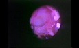 Functional Endoscopic Sinus Surgery - Anatomical Demostration - Part 4 of 5